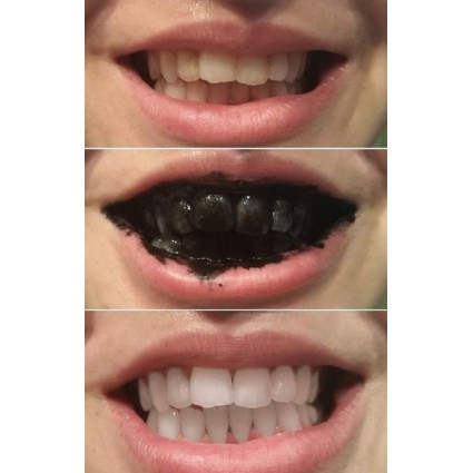 Blanchisseur de Dents Teeth Whitening